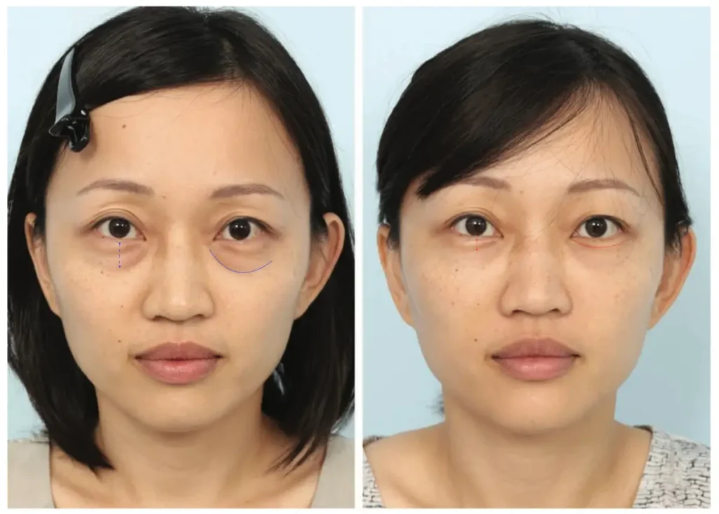 결막하 눈밑지방재배치