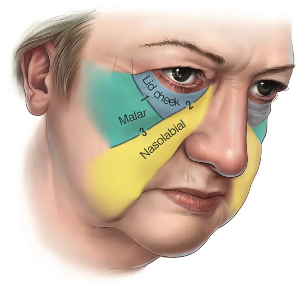 눈밑 노화 모식도