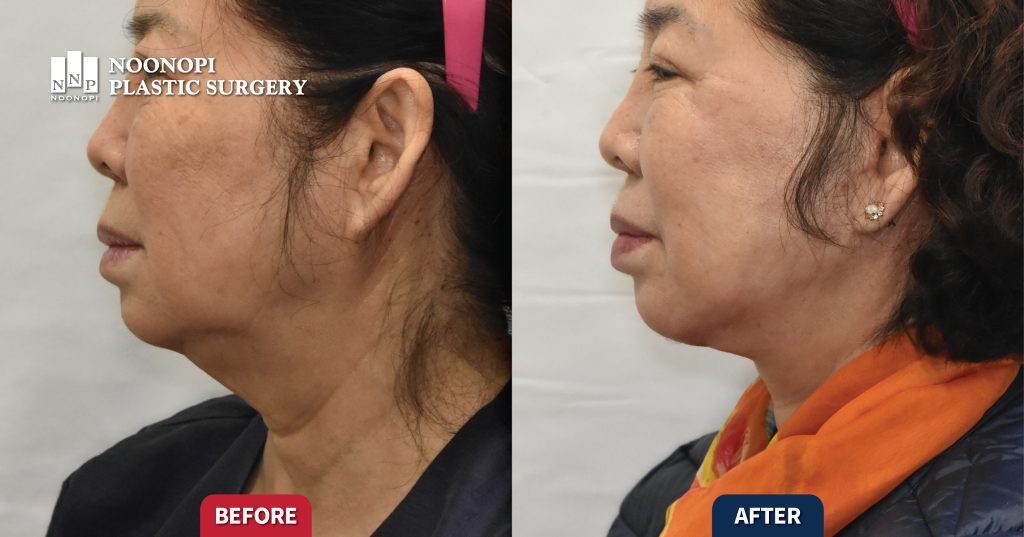 Works 안면거상 부작용과 수술 결과 판별법 002