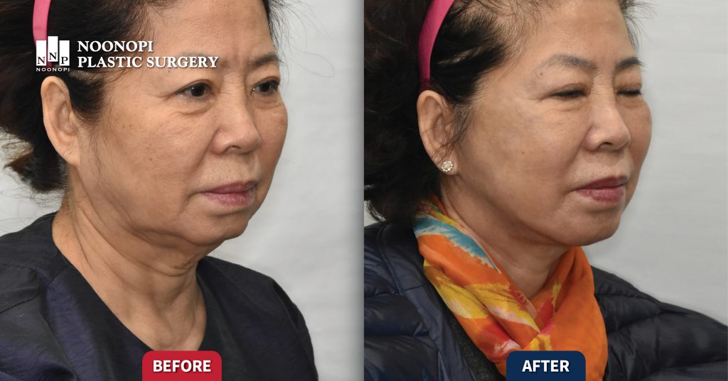 Works 안면거상 부작용과 수술 결과 판별법 003