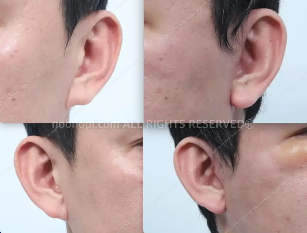 earlobe reduction