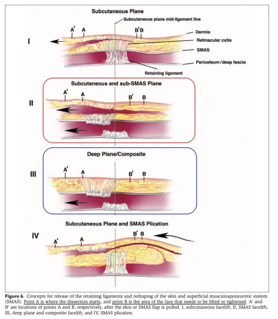 facelift procedure