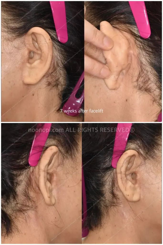 facelift scars behind ears pictures