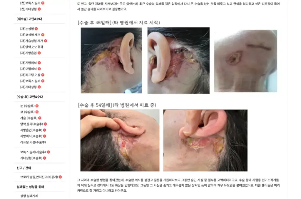 skin necrosis after facelift