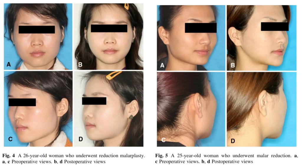 광대축소-중국-논문