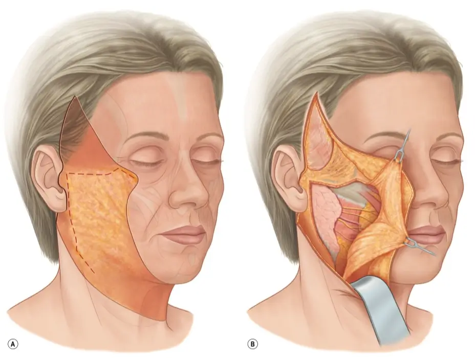 Extended SMAS Facelift