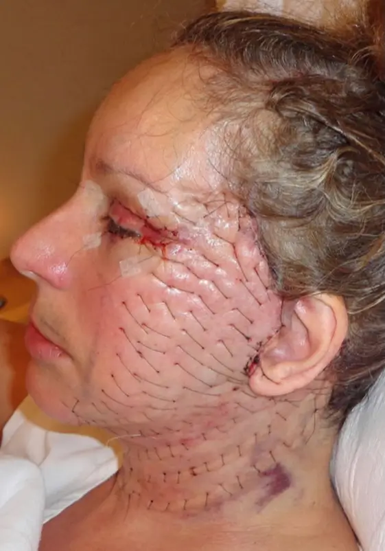 facelift hematoma prevention