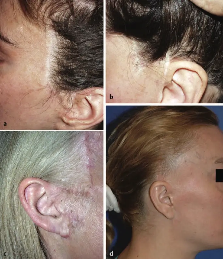 hairline receding after facelift