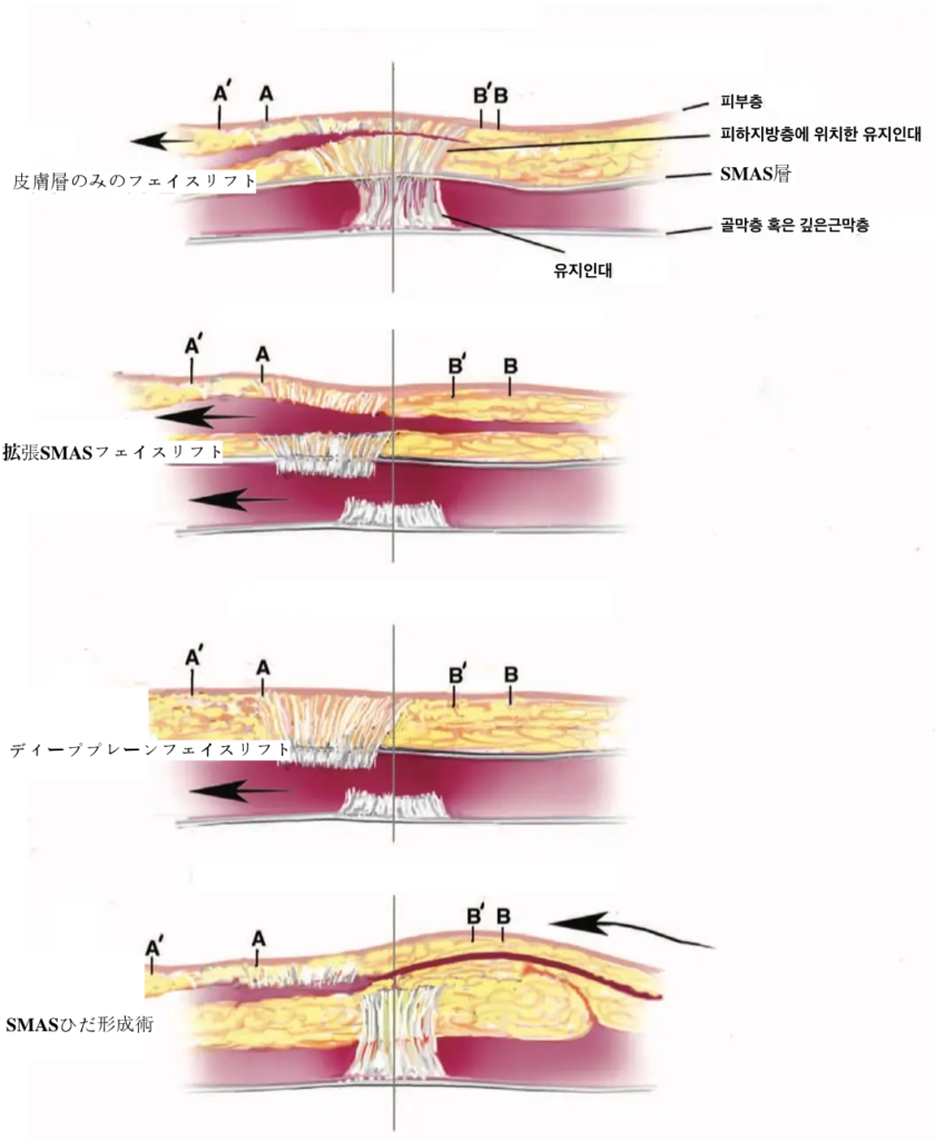 フェイスリフト 手術方法
