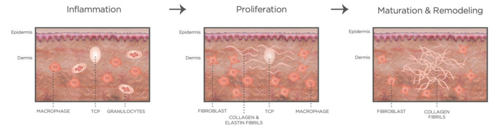 울쎄라-TCP