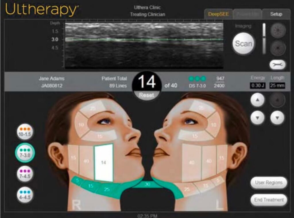 울쎄라-모니터