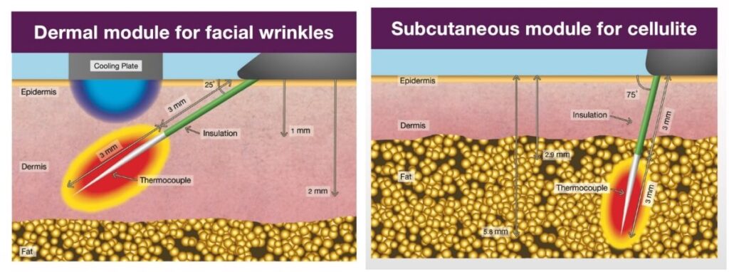 프로파운드-바늘깊이