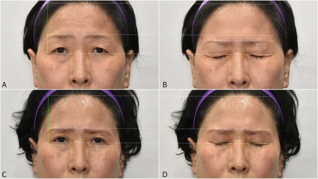 brow-height-changes-after-surgery 