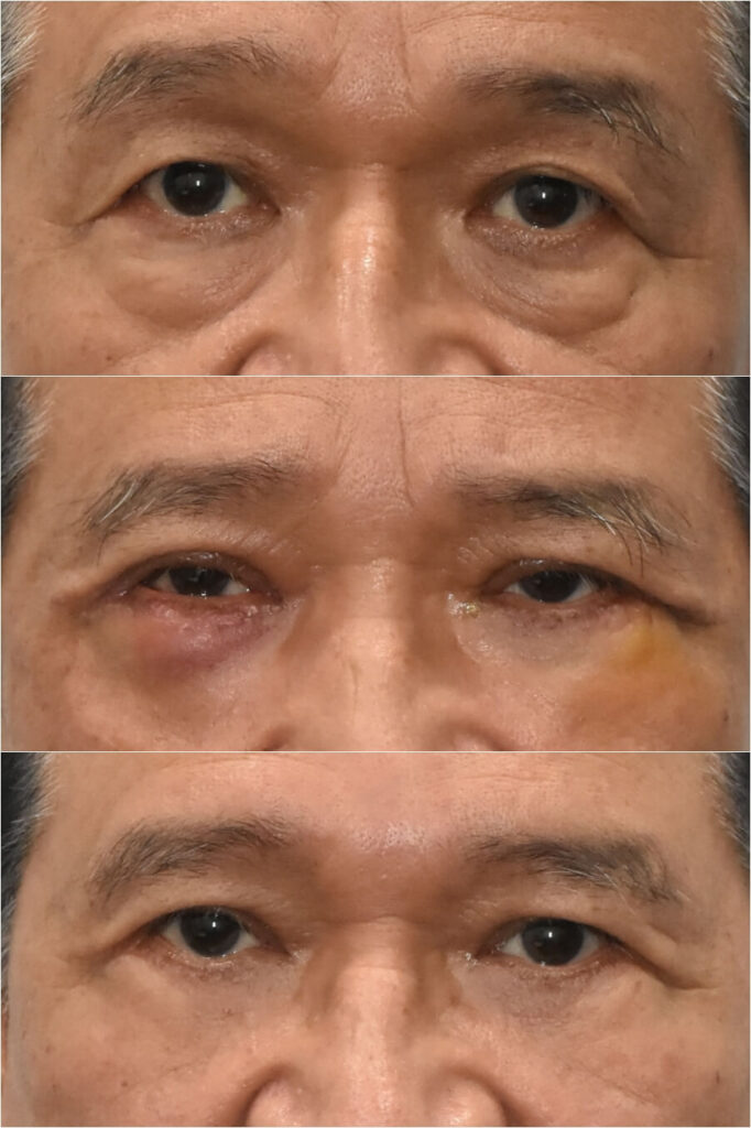 눈성형-혈종-오일낭종