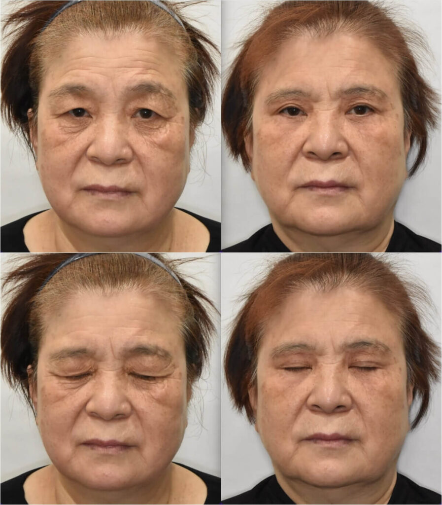 lower-blepharoplasty-before-after