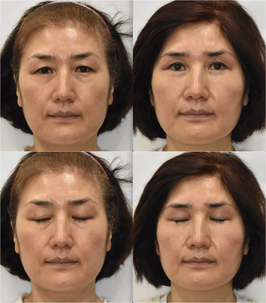 browpexy-before-after