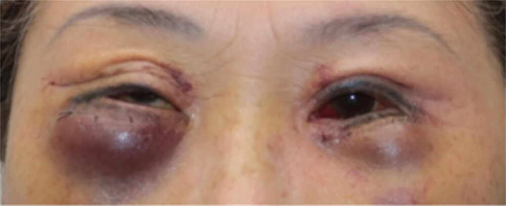 눈 성형 응급상황