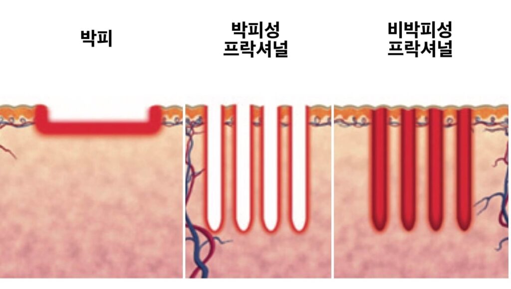 박피 비박피 프락셔널 비교