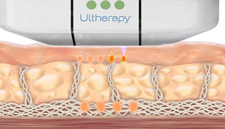 ultherapy-collagen