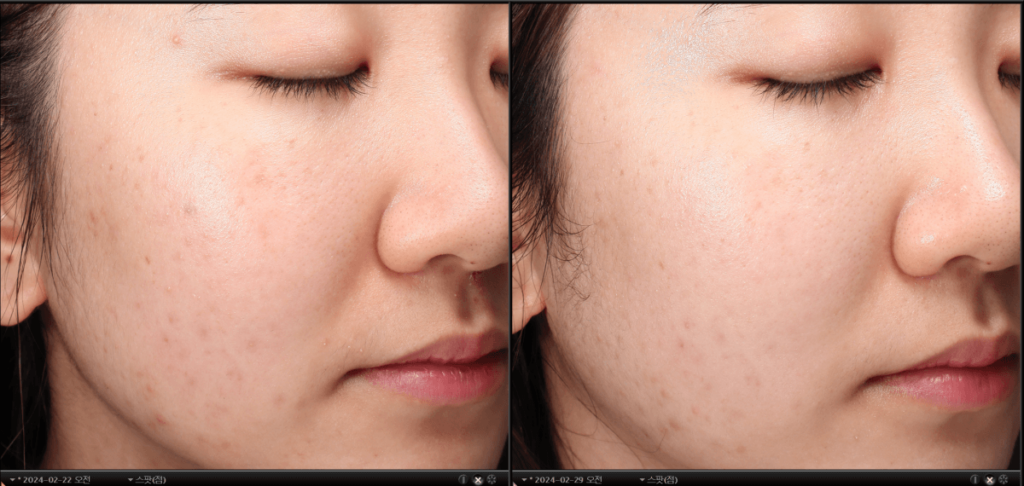 acne-laser-treatment