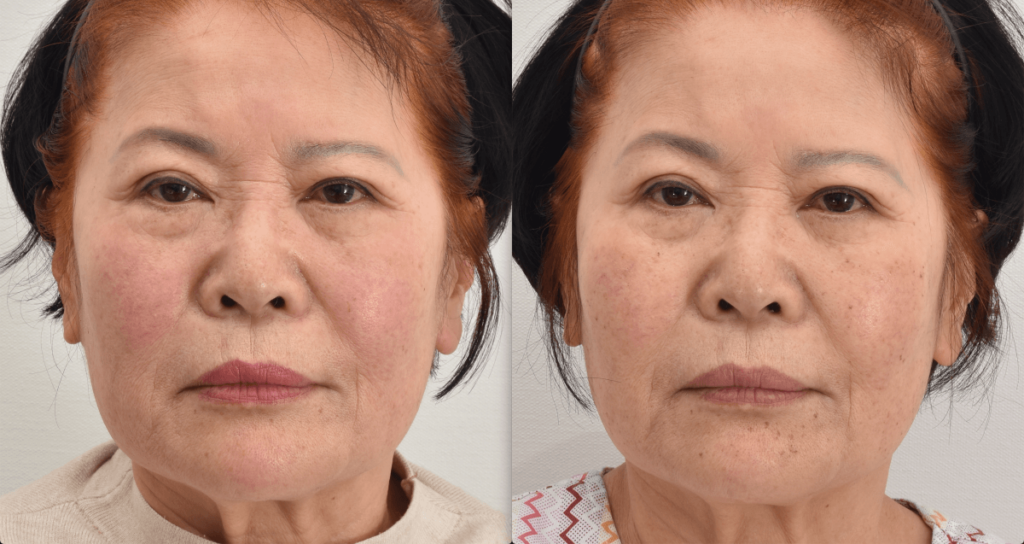facial-redness-flushing-korea