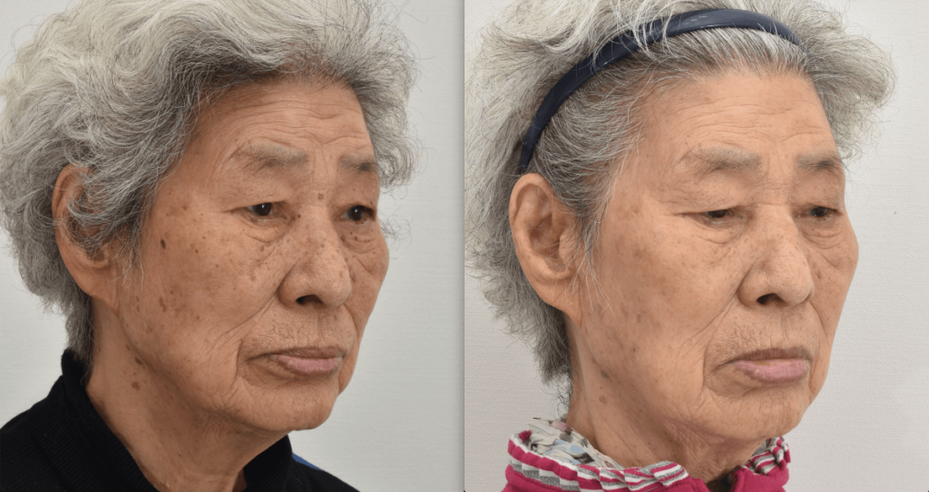 pigment-lesion-korea