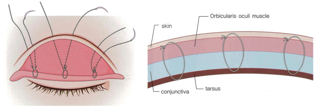 buried-double-eyelid