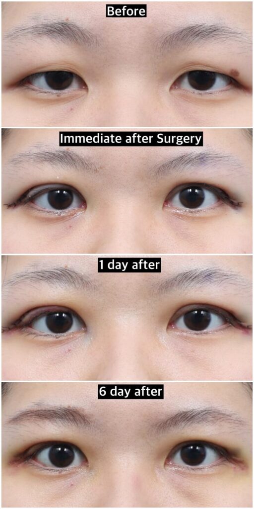 double-eyelid-surgery