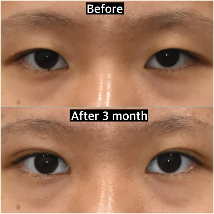 double-eyelid-before-after-korea