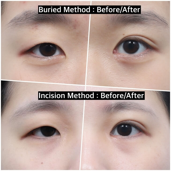 double-eyelid-surgery-korea