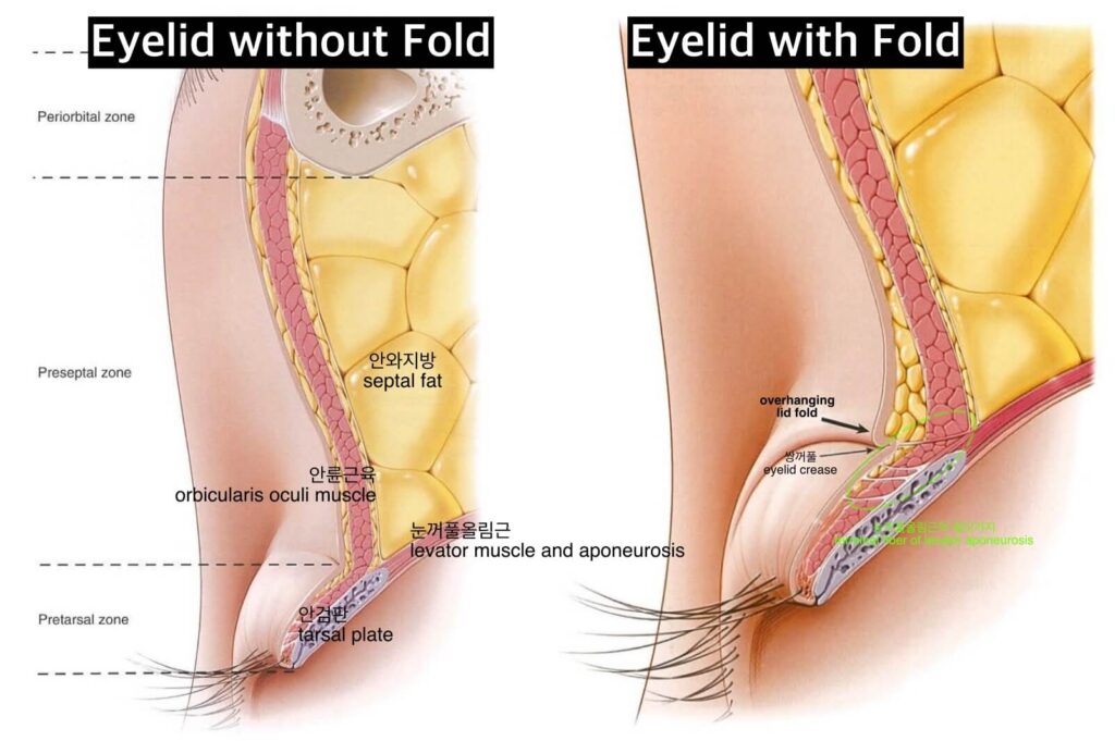mono-vs-double-eyelid
