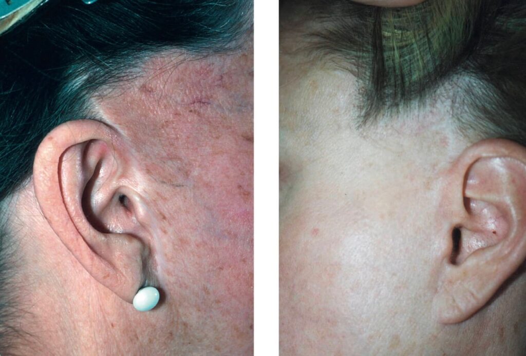 facelift incision scar