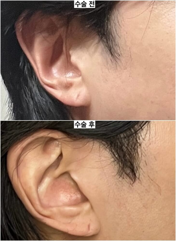 Before-and-after-facelift