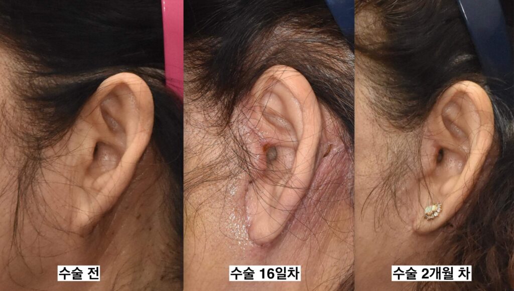 facelift earlobes