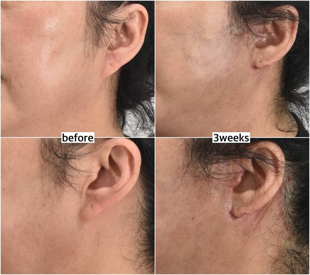 facelift incision post op