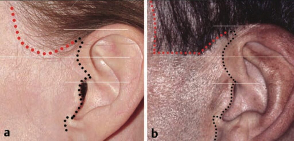 Facelift incision placement