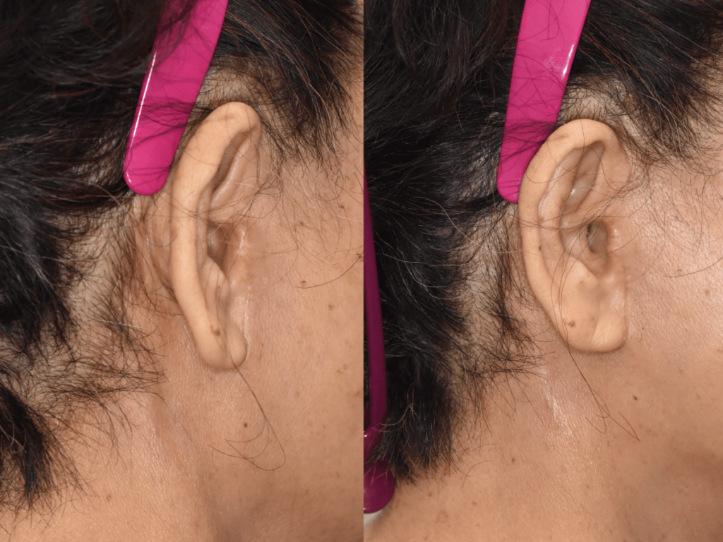 facelift incision post op