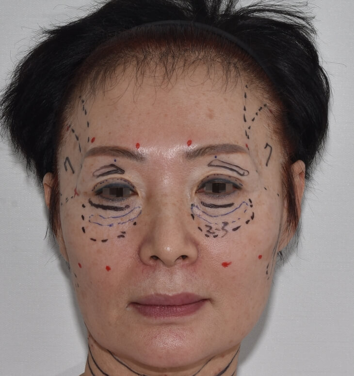 facial-fat-graft-design