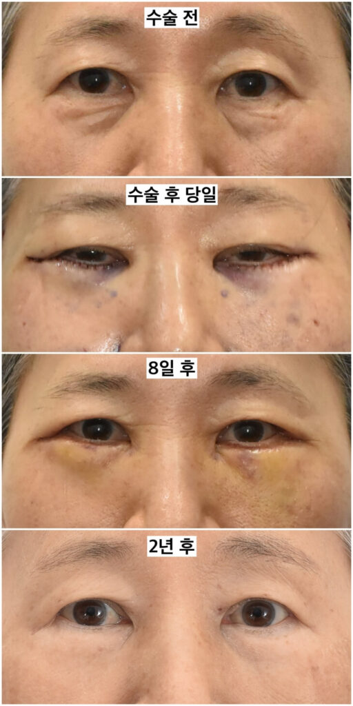 facial fat transfer after 2 years