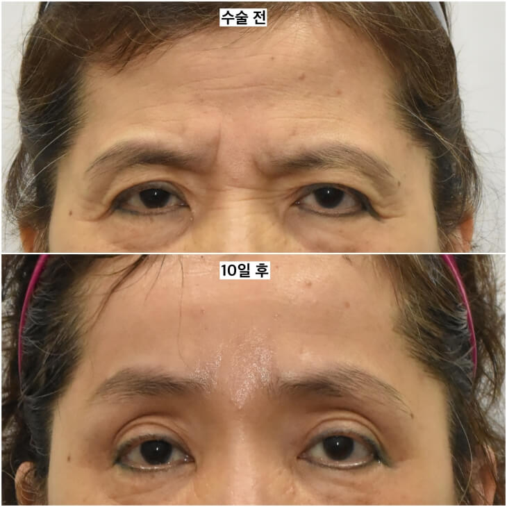 less upper eyelid fat