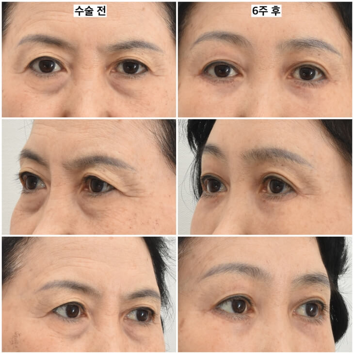 fat graft around eyes case