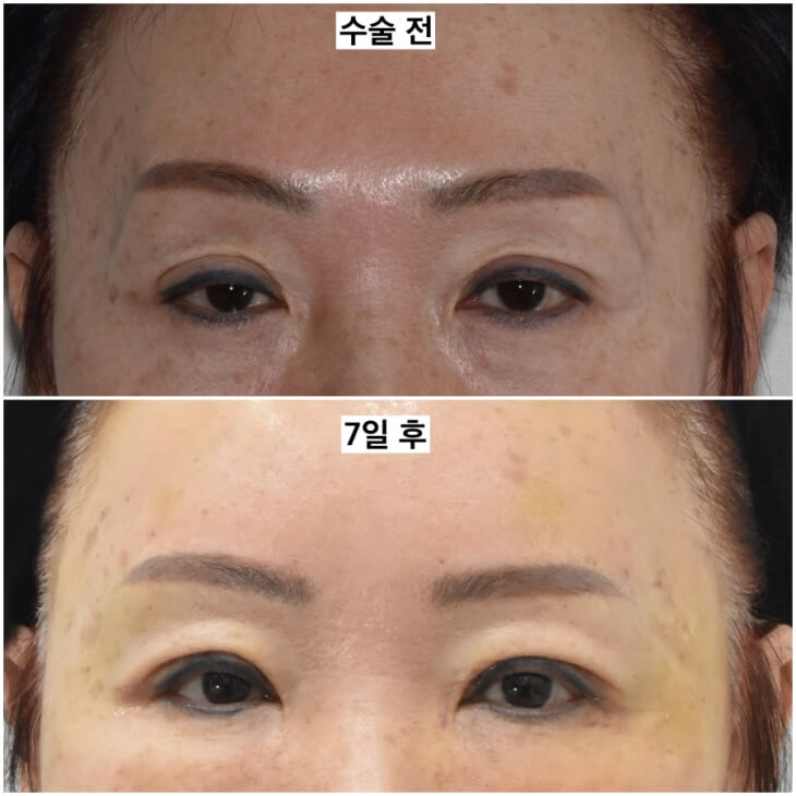 ptosis correction fat graft