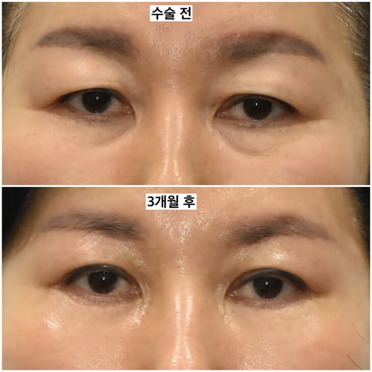 fat graft under eyes