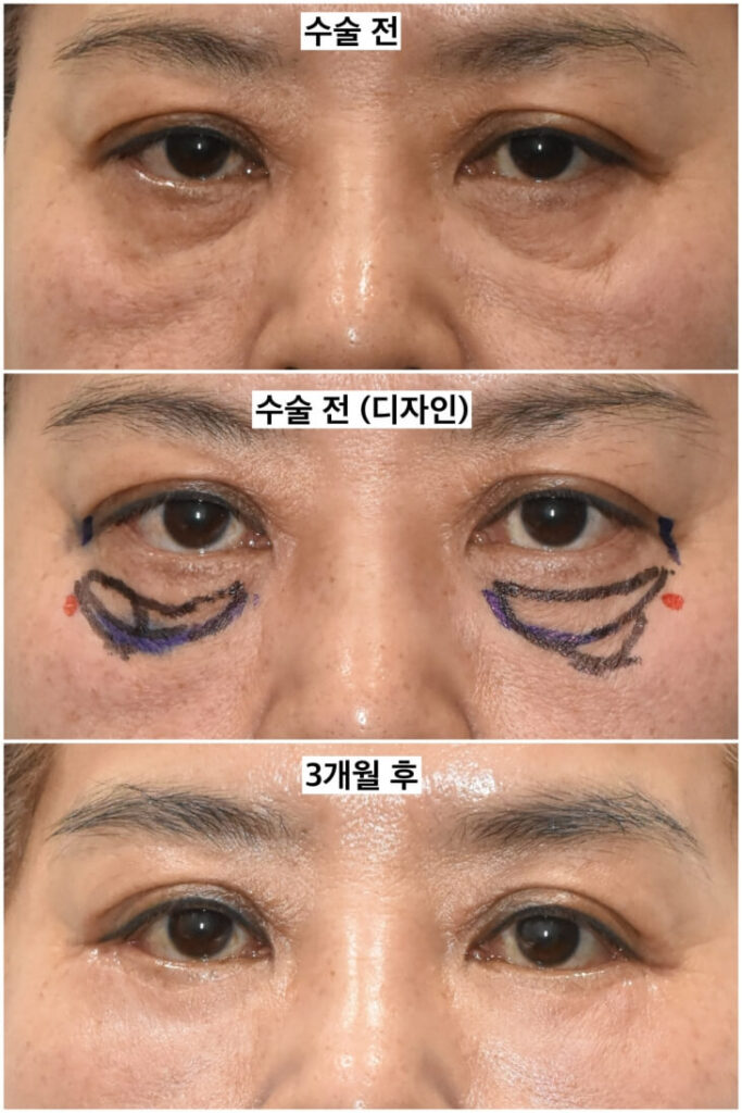 fat transfer around eyes