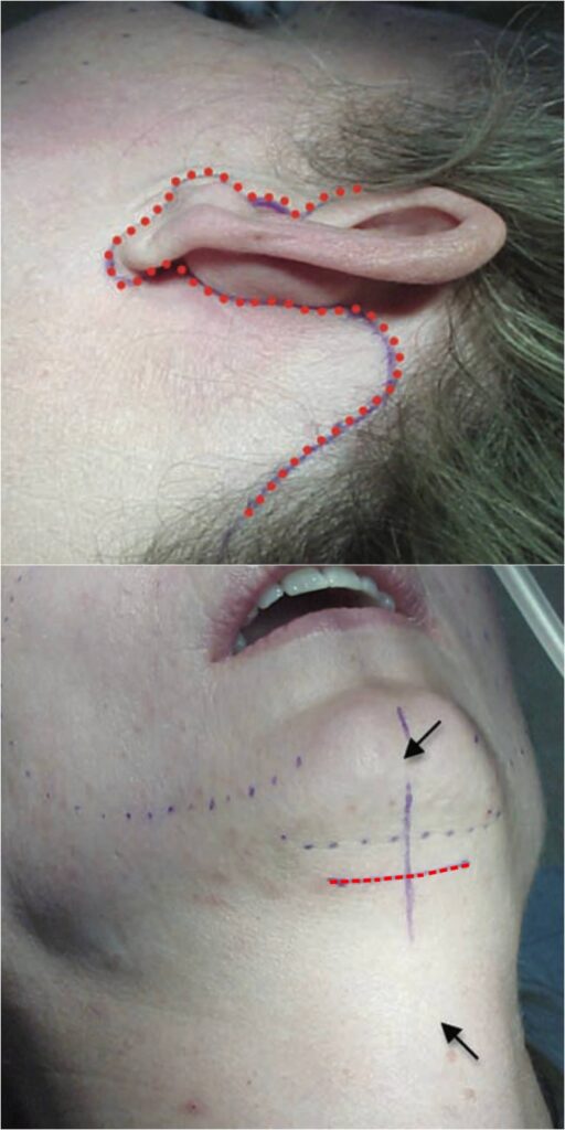 incision-location-neck-lift