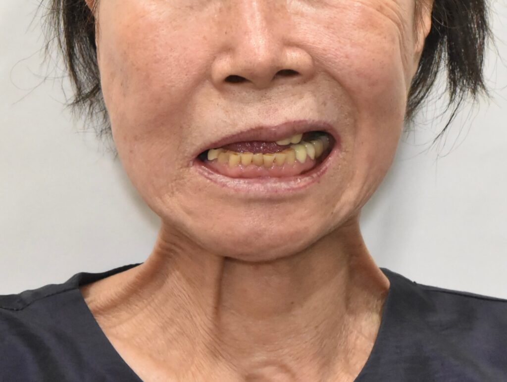 facelift-nerve-injury