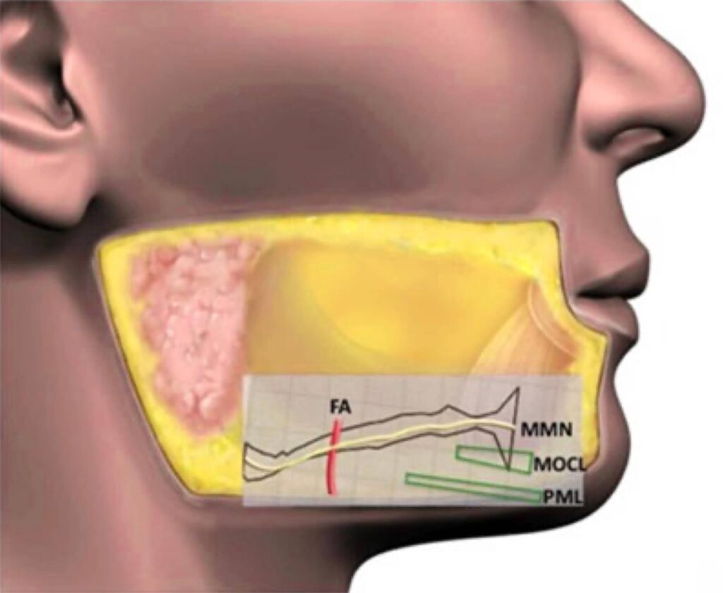 marginal-mandibular-nerve-mandibular-ligament