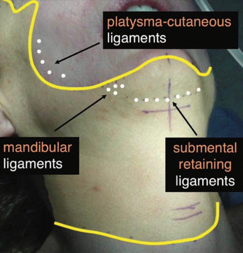 submental-incision-neck-lift