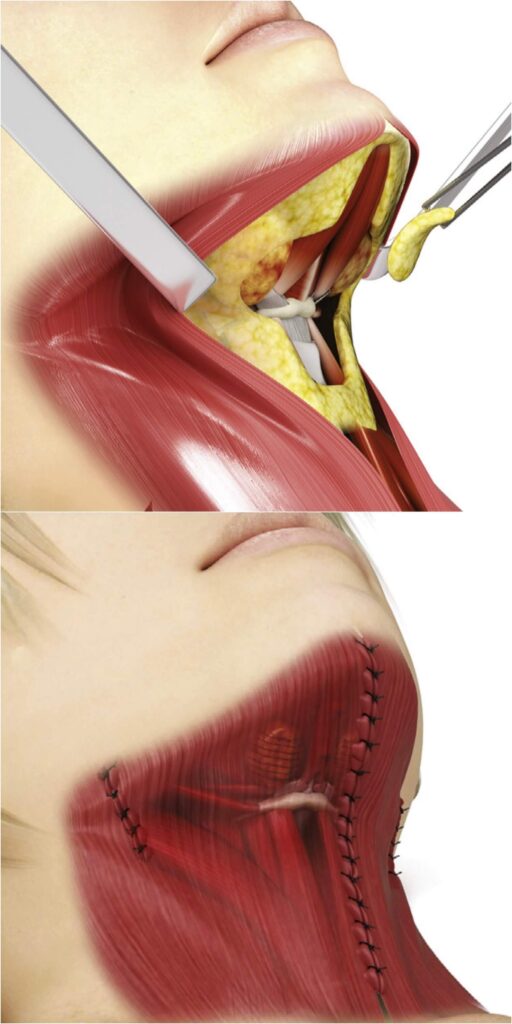Neck-lift-platysma-muscle