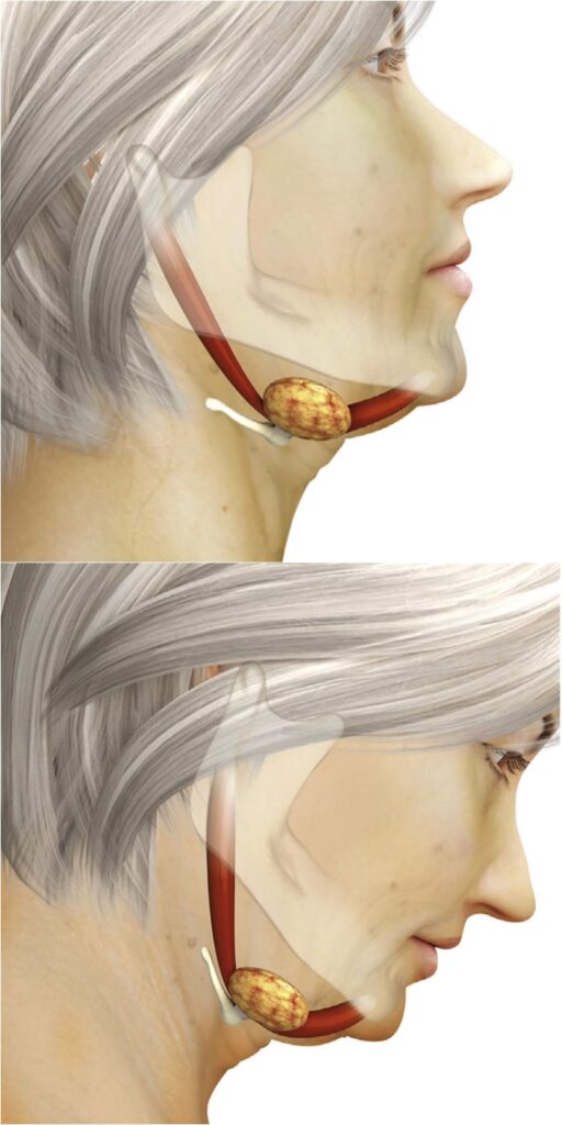 Double-chin-deformity